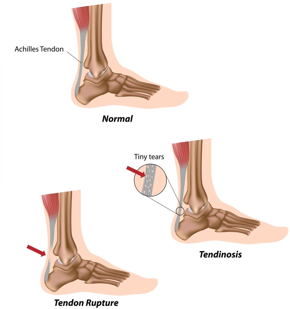 Achilles Tendon Rupture