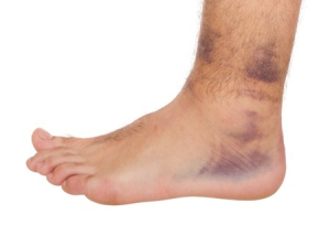 Sprained Ankle Symptoms