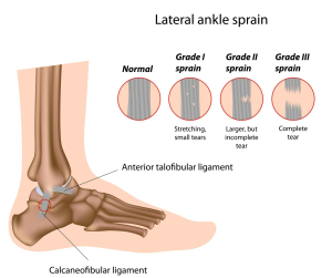 Sprained Ankle