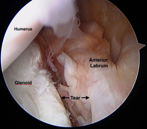 Labral Tears of the Shoulder