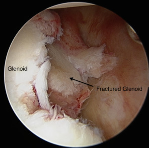 Shoulder Instability