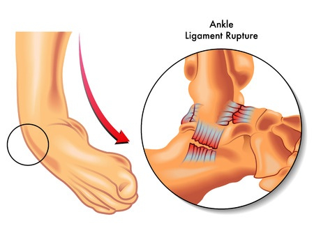 Signs and Treatment for Sprained Ankles