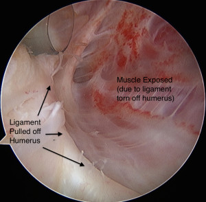 Shoulder Instability