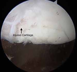 Patellar Dislocation Surgery