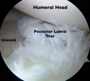 Labral Tears of the Shoulder