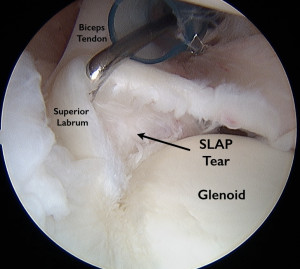 Labral Tears of the Shoulder