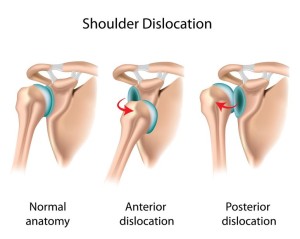 Shoulder Instability