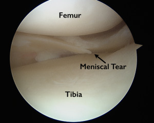 Torn Meniscus