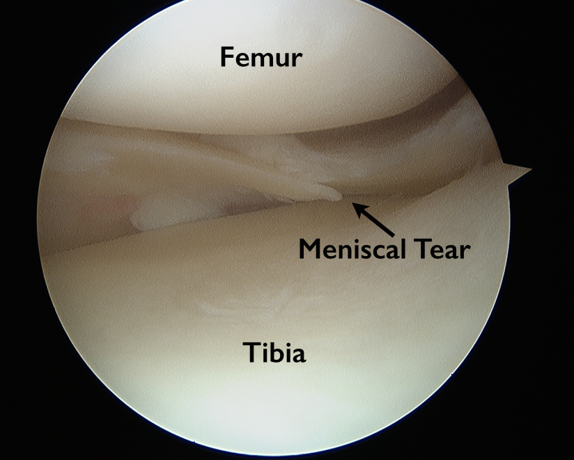 Knee Anatomy Torn Meniscus