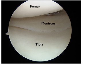 Torn Meniscus