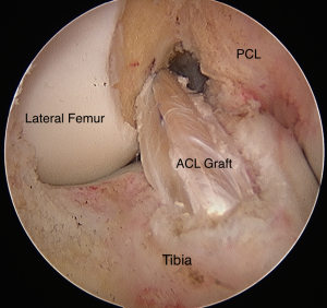 Torn ACLR Surgery