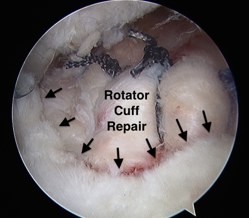 Rotator Cuff Tear Surgery