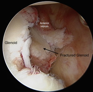 Bankart Lesion 