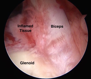 Adhesive Capsulitis