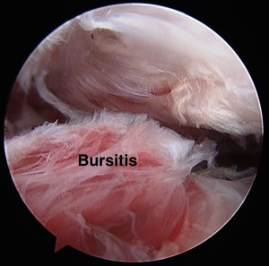 Adhesive Capsulitis