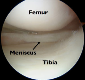 Torn Meniscus Recovery Time