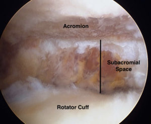 Impingement Syndrome Surgery