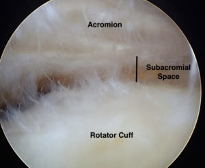 Impingement Syndrome Surgery