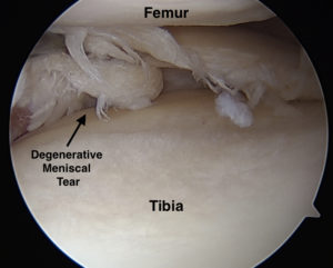 Degenerative Meniscal Tears