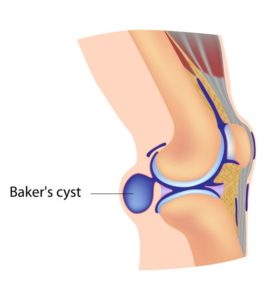 Baker's Cyst