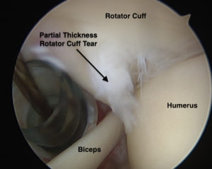 Partial Thickness Rotator Cuff Tears