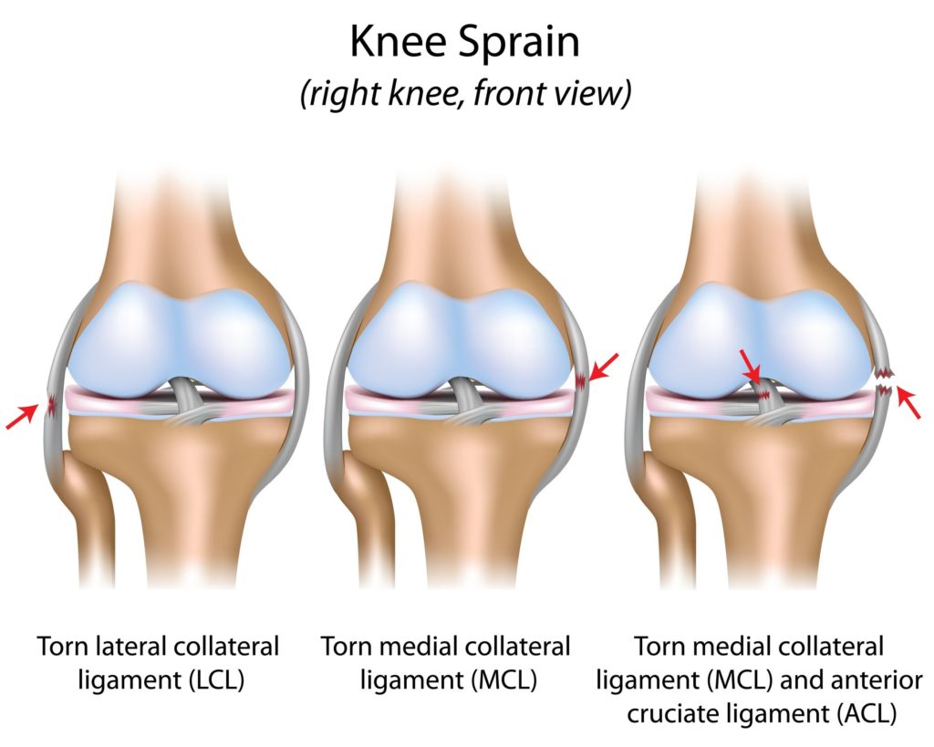 MCL Sprain