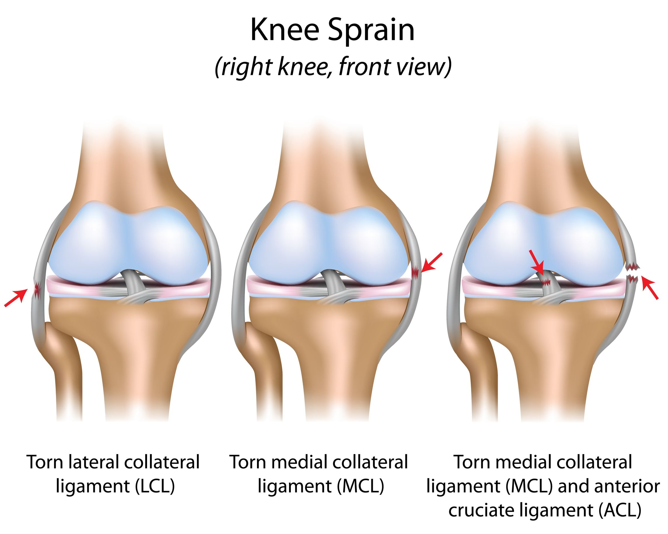 Повреждения мениска коленного сустава как лечить. Повреждение боковых связок коленного сустава. Растяжение сбоку коленного сустава. Разрыв боковой связки коленного сустава. Симптомы повреждения сухожилия коленного сустава.