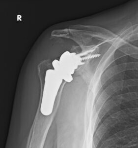 Shoulder Arthritis Treatment