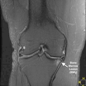 Subchondroplasty