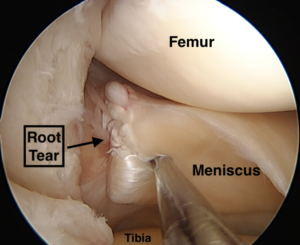 Root Tears