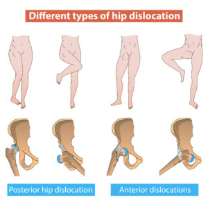 Hip Dislocation