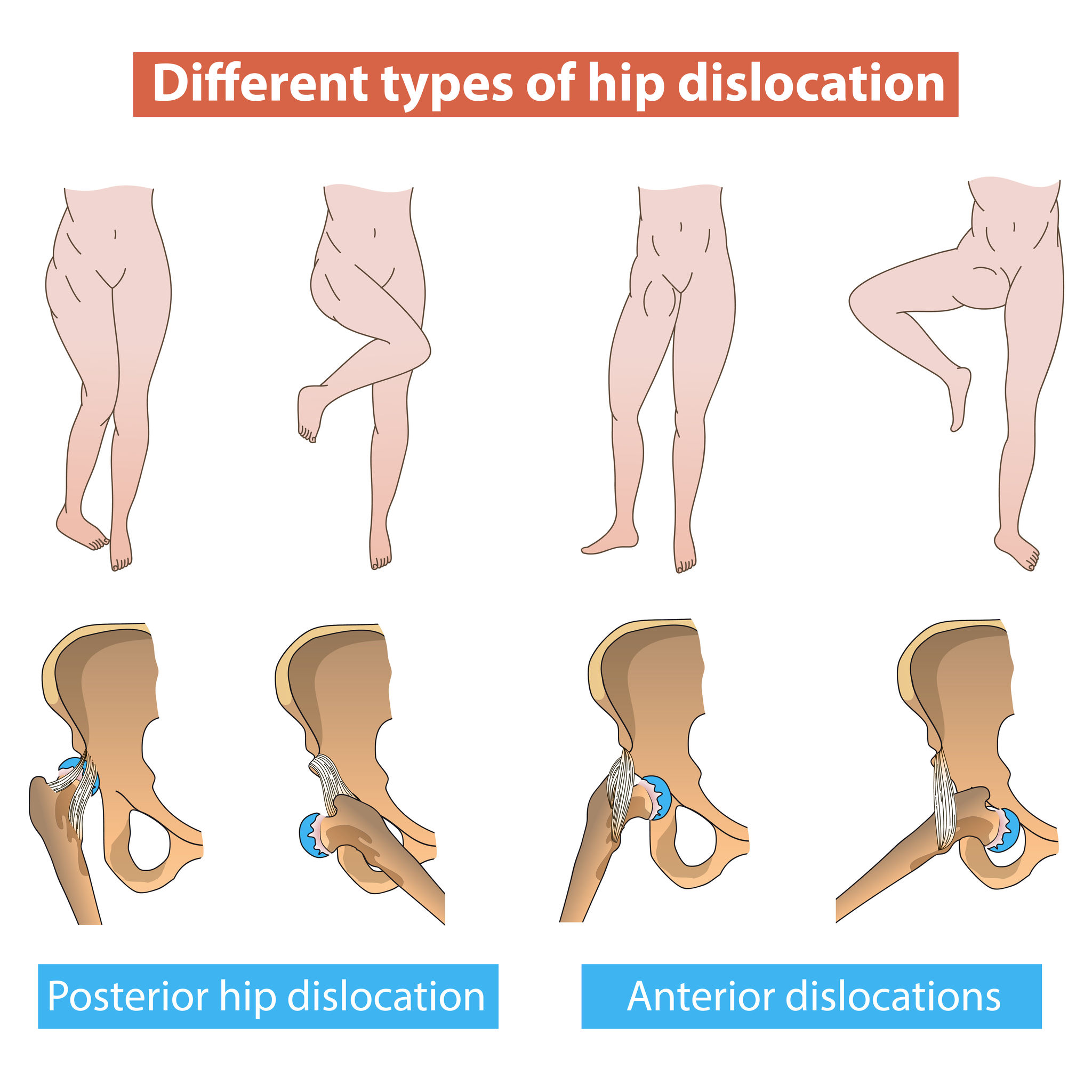 Hip Dislocation: Tua Tagovailoa’s Injury - Jeffrey H. Berg, M.D.