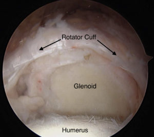 Irreparable Rotator Cuff Tear