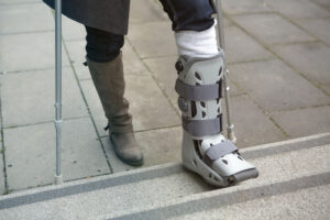 Ankle Fracture Treatment